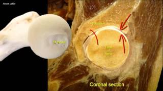 Femoral neck fracture  applied anatomy [upl. by Critchfield814]