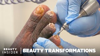 How Medical Pedicures Transform Feet [upl. by Aimahs456]