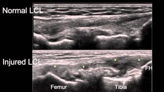 Sonographic Examination of Knee Ligaments [upl. by Ludly718]