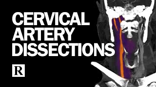 Cervical Arterial Dissections [upl. by Willey364]