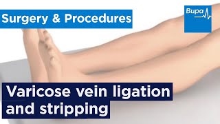 How varicose vein ligation and stripping is carried out  Bupa Health [upl. by Gerbold]