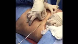 Tumescent Liposuction for Fat Removal [upl. by Ever]