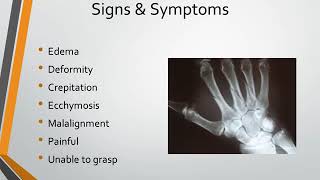 Metacarpal Fracture [upl. by Ellerrehc]