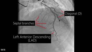 Coronary angiogram  a live demonstration [upl. by Ydnec]