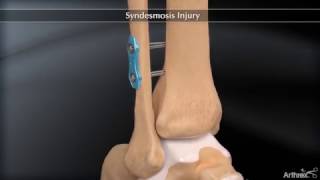 Syndesmosis Injury [upl. by Gardiner]