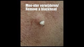 Grote meeeter verwijderen  Remove a big blackhead [upl. by Yehs]