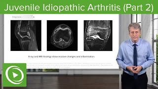 Understanding Juvenile Idiopathic Arthritis JIA  Jumo Health [upl. by Wertz]