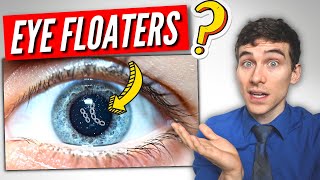 3 Must Know Facts About EYE Floaters [upl. by Aicen]