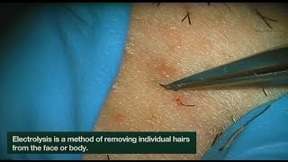 Electrolysis Ingrown Hair Removal  CLOSEUP  Here is how Electrolysis works  Jade Clinics [upl. by Marfe]