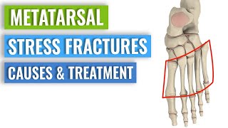 Metatarsal Stress Fractures  Causes Treatment Prevention [upl. by Noiemad]