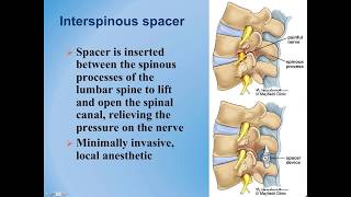 Lumbar Spinal Stenosis  Diagnosis and Treatment Options [upl. by Mayor111]