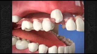 Flexible Partial Dentures [upl. by Germann]