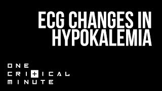 ECG Changes in Hypokalemia  One Critical Minute 1CM [upl. by Husain]