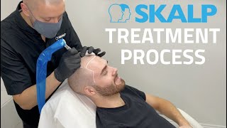 Skalp® Scalp Micropigmentation Treatment Process [upl. by Milla357]