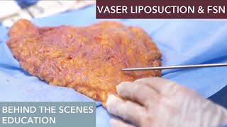 The Science Behind Vaser Liposuction How Does It Work [upl. by Kiona]