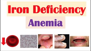 IronDeficiency Anemia Overview  Causes Pathophysiology Signs amp Symptoms Diagnosis Treatment [upl. by Ariajaj]