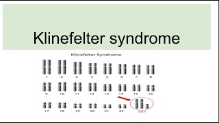 Klinefelter syndromeGenetics Characteristics Diagnosis [upl. by Kilam]