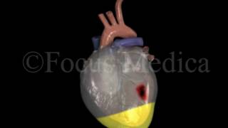 Pericardial effusion  Heart [upl. by Hardie]