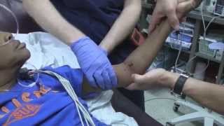 Posterior Elbow Dislocation Reduction [upl. by Crisey]