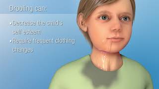 Sialorrhea Excessive Drooling  Decreasing Saliva Production [upl. by Nimra]