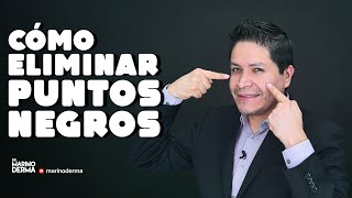 COMO ELIMINAR PUNTOS NEGROS  Dr Marino Dermatologo [upl. by Gainor]