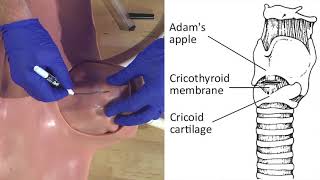 Emergency Needle Cricothyrotomy Procedure Explained [upl. by Marcella]