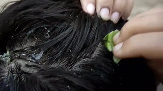 aloe vera gel for hair  dandruff treatment at home  bal se dandruff kaise hataye [upl. by Relyuc67]