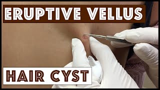 Unusual types of Cysts Eruptive Vellus Hair Cysts Part 1 in a Series [upl. by Skip920]