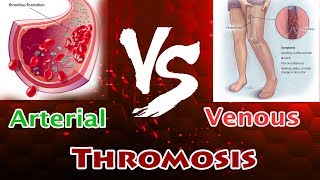 Pulmonary Embolism Remastered  Pathophysiology Symptoms Diagnosis DVT [upl. by Ahseinek731]