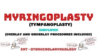 Myringoplasty Tympanoplasty  Ear surgeries  Overlay and Underlay  ENT  Otorhinolaryngology [upl. by Latsyrhk308]