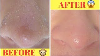 How To Treat Eczema Naturally [upl. by Arremat]