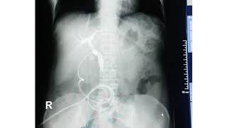 T Tube Cholangiography [upl. by Burbank]