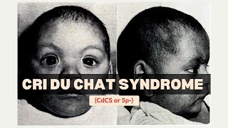 Cri Du Chat Syndrome CdCS or 5p  Genetics  Medicine [upl. by Yona613]