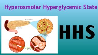 Hyperosmolar Hyperglycemic State  HHS [upl. by Mungam]