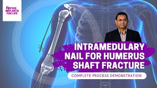 Intramedullary Nail For Humerus Shaft Fracture Procedure [upl. by Annekahs]