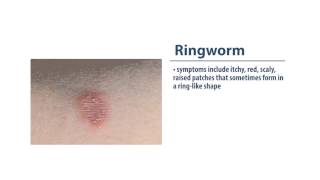 Skin Infections Ringworm [upl. by Duong]