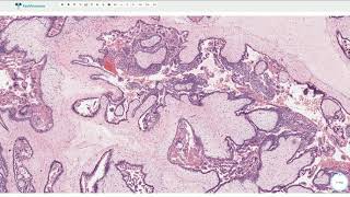 Complete Hydatidiform Mole  Histopathology [upl. by Cram]