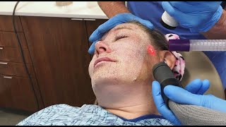 Full Face Fractional CO2 Laser Resurfacing for Wrinkles and Skin Tightening [upl. by Leach]