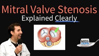 When Should The Mitral Valve Be Repaired [upl. by Jakob586]