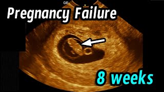 Early pregnancy failure 8 weeks 2 days [upl. by Camden]