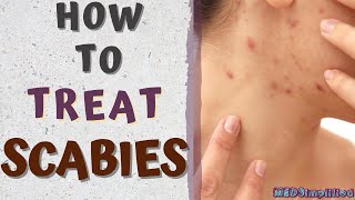 HOW TO TREAT SCABIESscabies treatment at home [upl. by Annaya302]