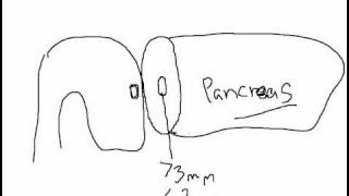 Post Anesthesia Care Unit PACU What to Expect [upl. by Letnoj]