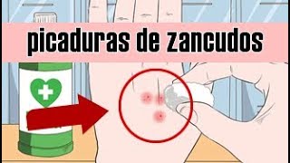 8 formas de aliviar picadura de zancudo  mosquito [upl. by Akere756]