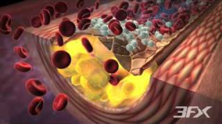 DiabetesRelated Atherosclerosis [upl. by Ahsuas]