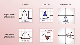 Intro to EKG Interpretation  Chamber Enlargement [upl. by Frere965]