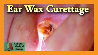 Ear Wax Removal of a Full Ear  Auburn Medical Group [upl. by Cohe]