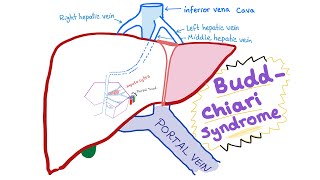 Focal Segmental Glomerulosclerosis  causes symptoms diagnosis treatment pathology [upl. by Hadden477]