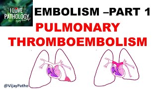 EMBOLISM Part 1 Pulmonary amp Systemic thromboembolism [upl. by Kristo]