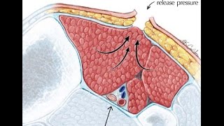 Compartment Syndrome [upl. by Sieracki754]