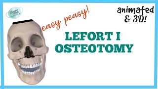 LEFORT I OSTEOTOMY  MAXILLARY OSTEOTOMY [upl. by Oicapot737]